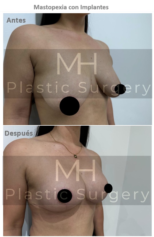 Mastopexia con implantes