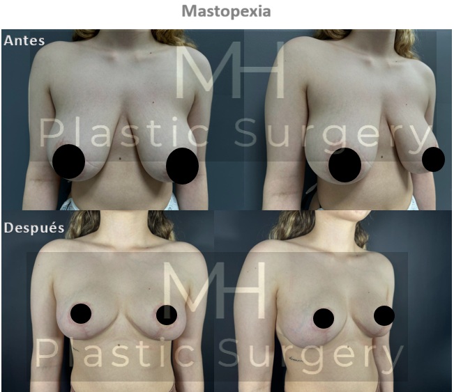 Mastopexia