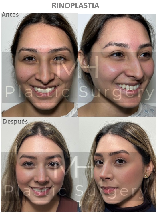 Rinoplastia