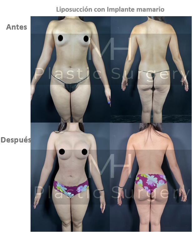 Lipo + Implantes